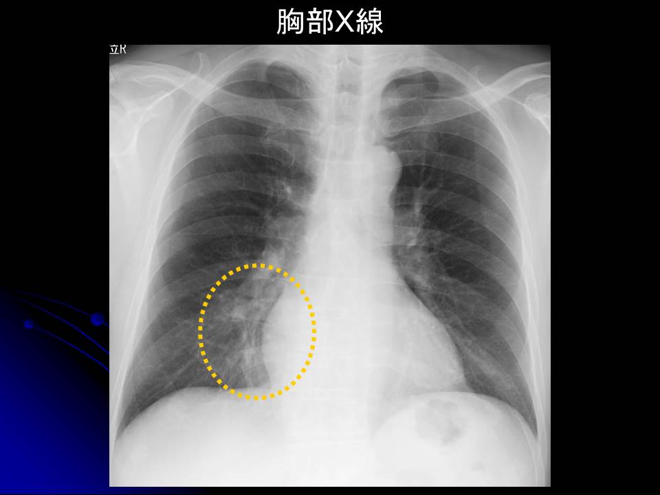 肺膿瘍　胸写