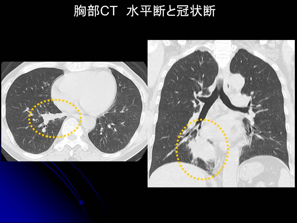 肺膿瘍　CT